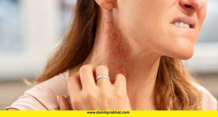 Skin Allergies