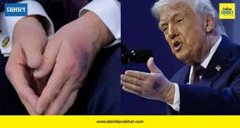 Donald Trump hand blue spot : डोनाल्ड ट्रम्प यांच्या हातावरील जखमेमागचं सत्य काय? व्हाईट हाऊसची मोठी हेल्थ अपडेट