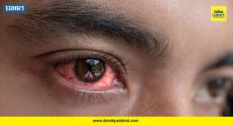 PCMC Health Alert : शहरात डोळे येण्याची साथ! शाळांना आणि पालकांना आरोग्य विभागाचा मोठा इशारा..वाचा