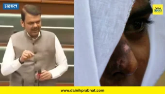 Devendra Fadnavis : ॲसिड पीडितांची ओळख गोपनीय राखणारे विधेयक मंजूर; मुख्यमंत्री देवेंद्र फडणवीस यांची माहीती