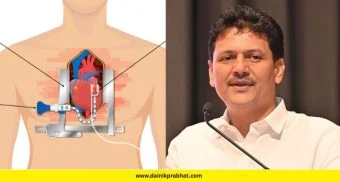 Free Bypass Surgery: आता बायपास सर्जरीसाठी एक रुपयाही लागणार नाही; आरोग्यमंत्र्यांची विधानसभेत मोठी घोषणा!