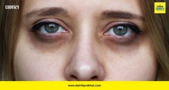 Dark circles: डार्क सर्कल्सची खरी कारणे उघड! झोपेव्यतिरिक्त या ५ गोष्टींमुळे वाढते समस्या
