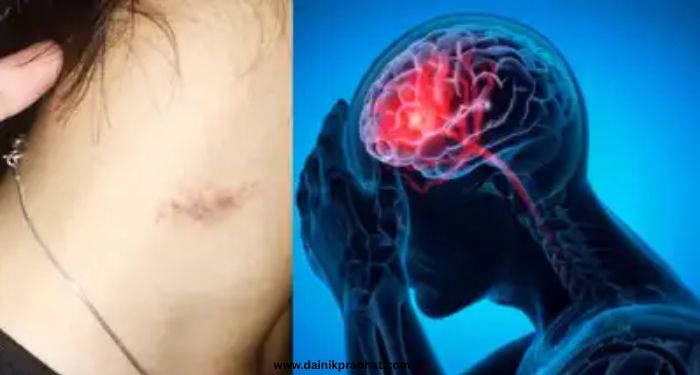 Love Bite Side Effect