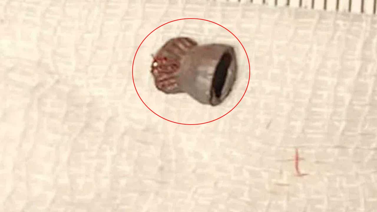 Air Gun Pellet | బాలుడి కంటిలో ఎయిర్ గ‌న్ పెల్లెట్.. విజ‌య‌వంతంగా తొలగించిన వైద్యులు